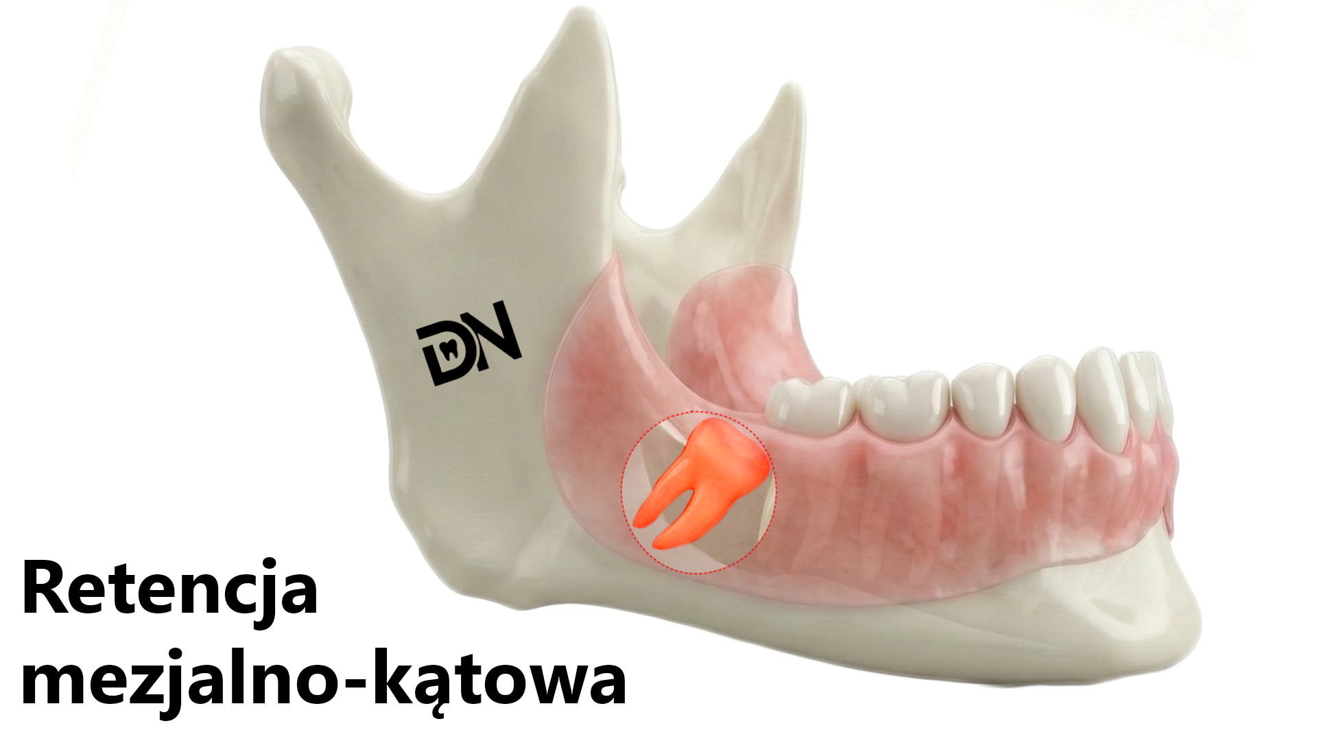 Mezjalno-kątowa (najczęstsza)(W)