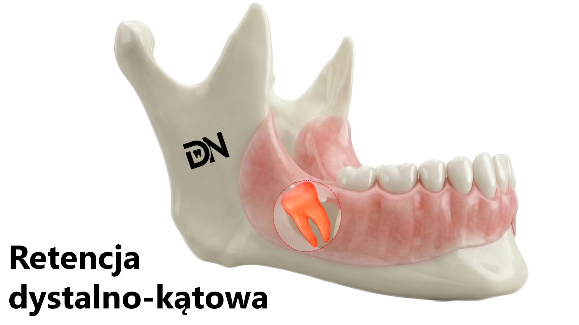 Dystalno-kątowa(W)