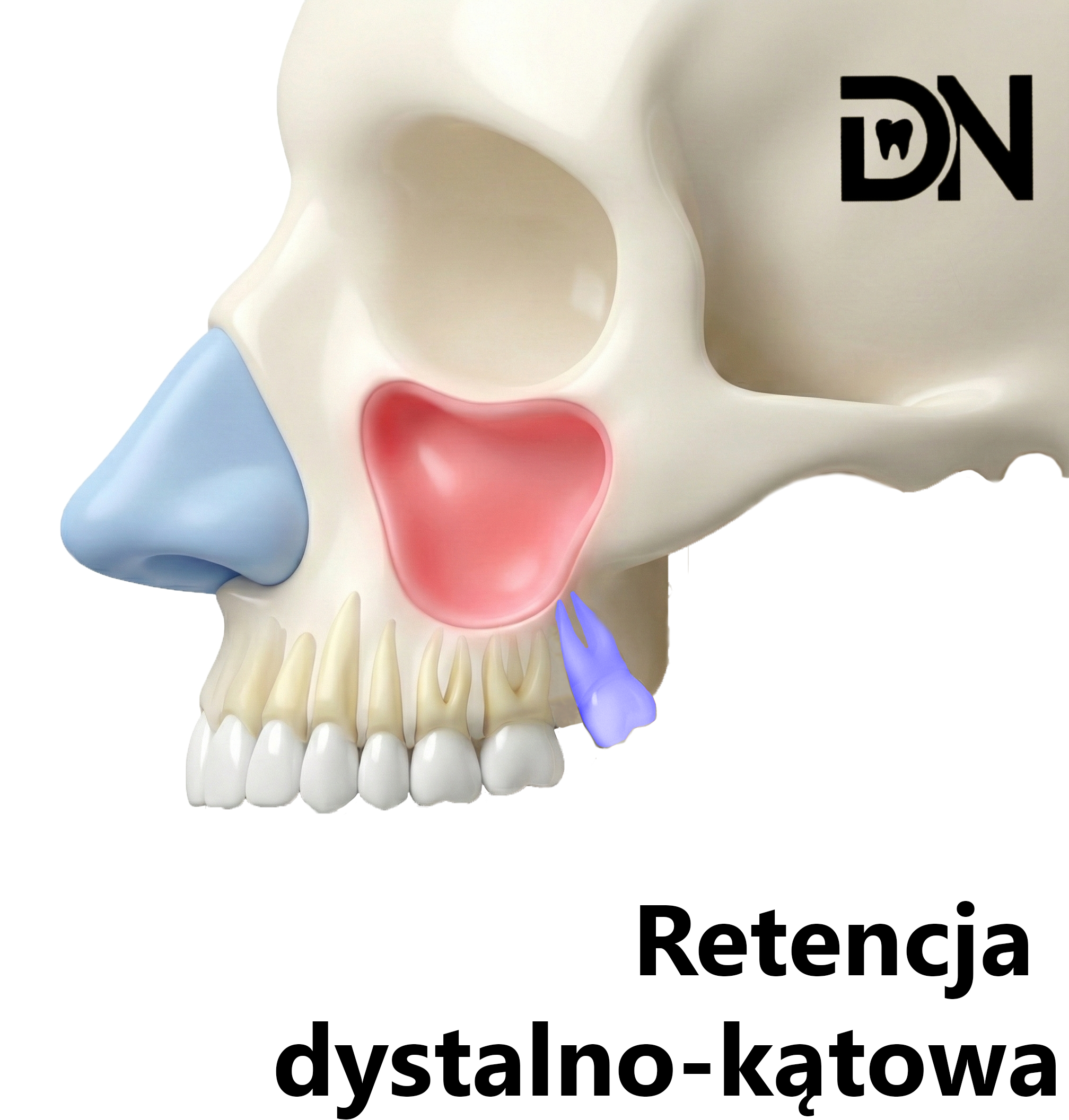 Dystalno-kątowa(A)