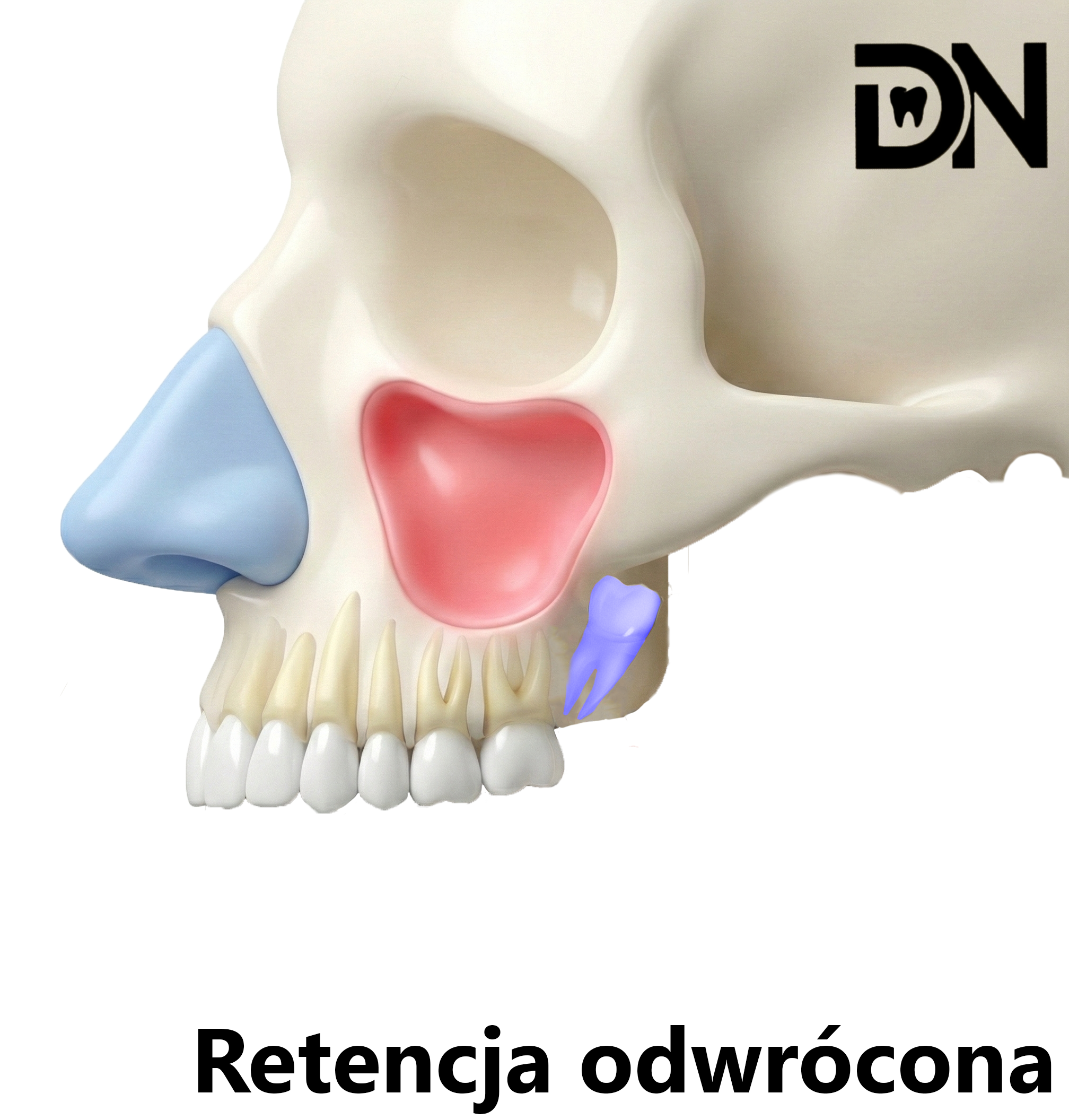 Odwrócona (korzenie do szczytu wyrostka, korona do zatoki)(A)