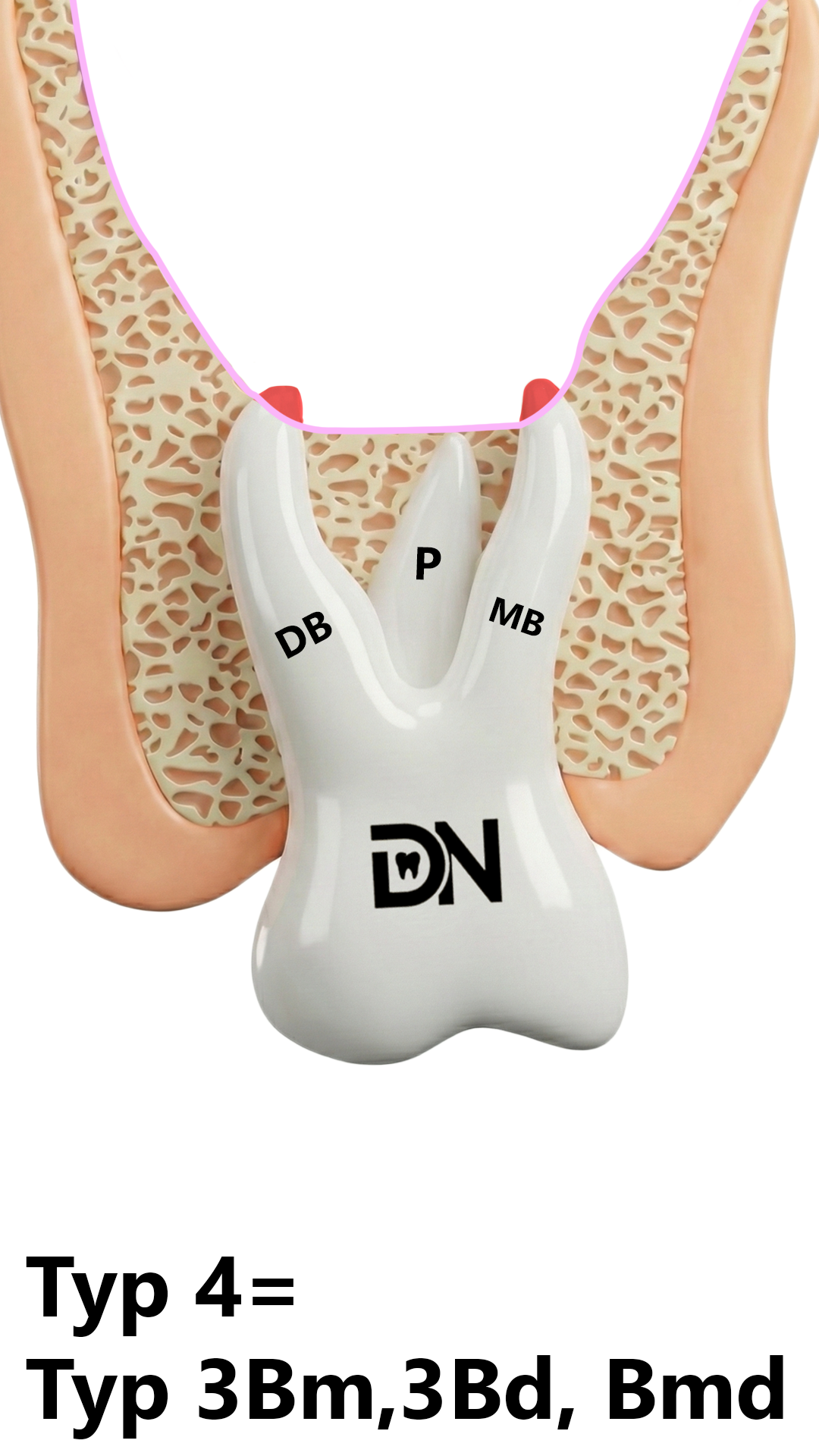 Typ 4  = Typ 3Bm, 3Bd, 3Bmd*