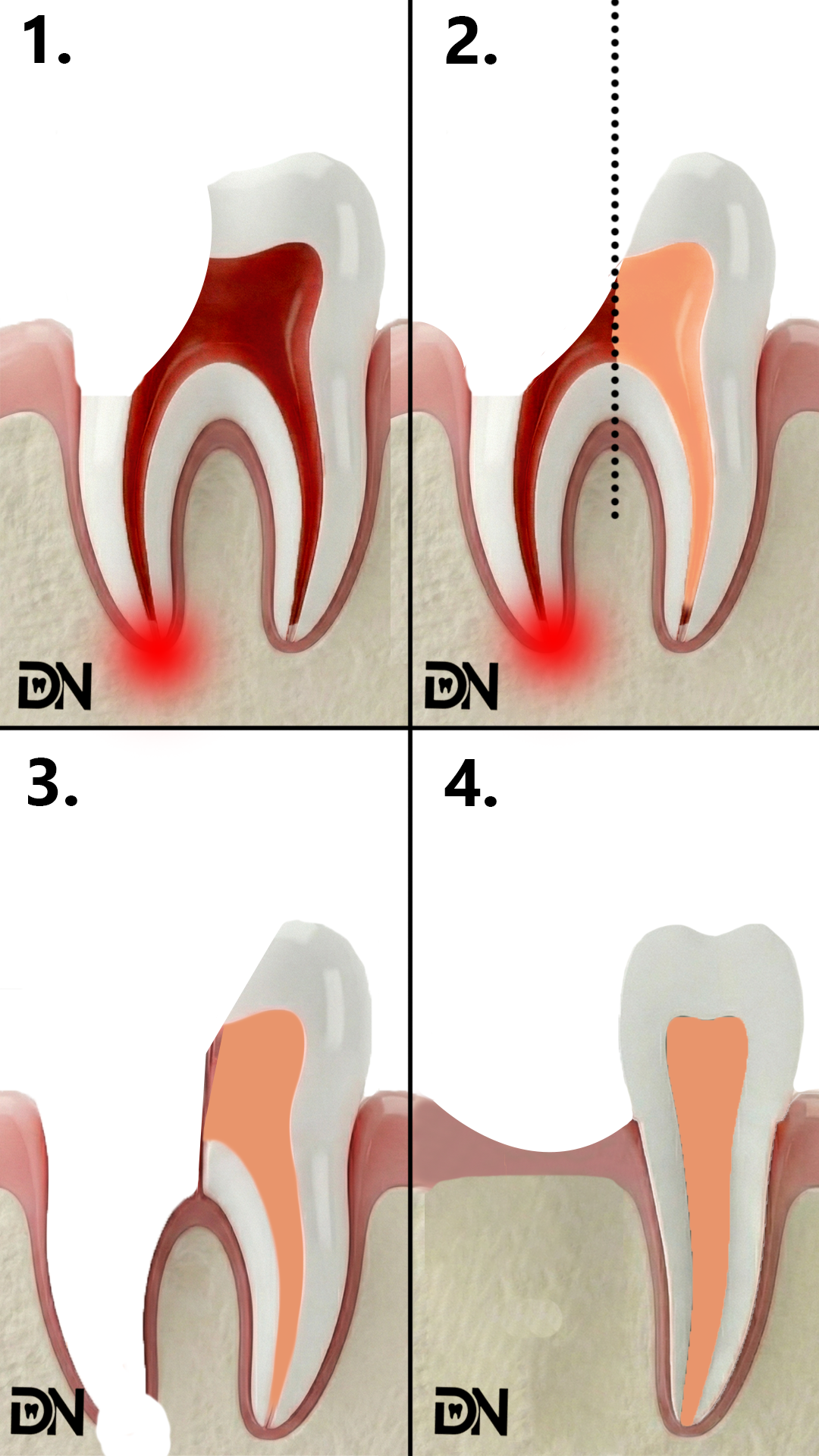 Hemisekcja